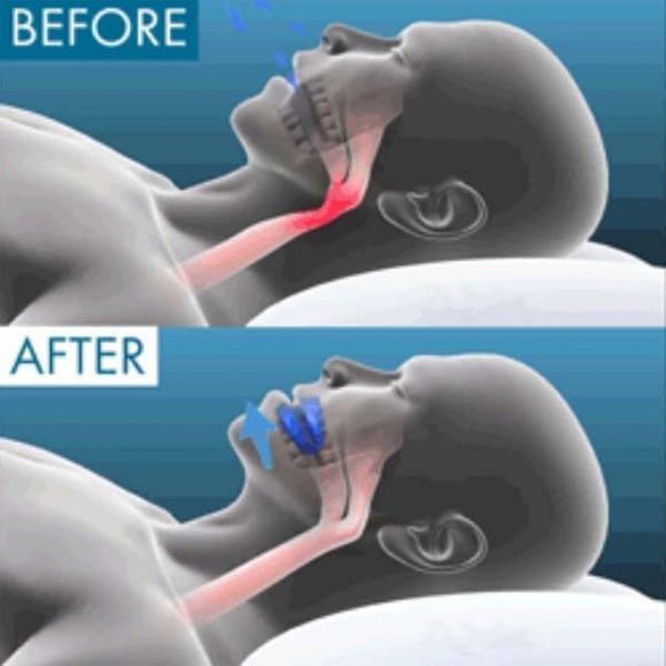 Protetor Bucal Anti-Ronco Zenoplex Pro 2.0