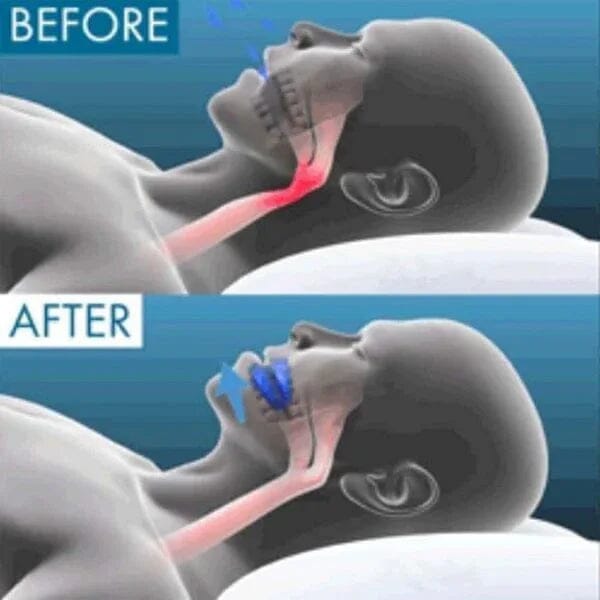 Protetor Bucal Anti-Ronco Zenoplex Pro 2.0 Znorex Borsato 