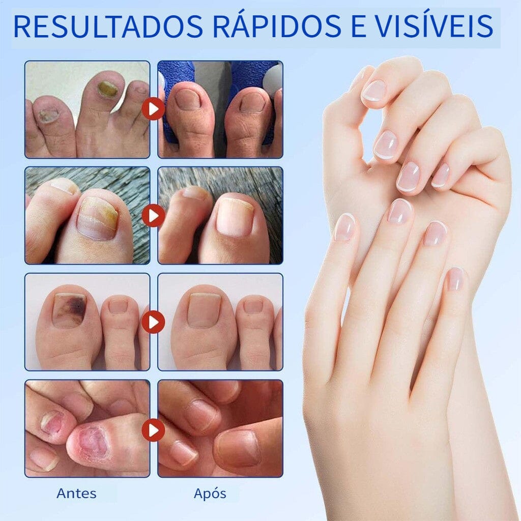 UngiGel - Adesivos para fungos UngiGel Borsato 